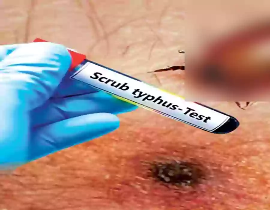 నాలుగేళ్ల చిన్నారికి స్క్రబ్ టైఫస్ వైరస్