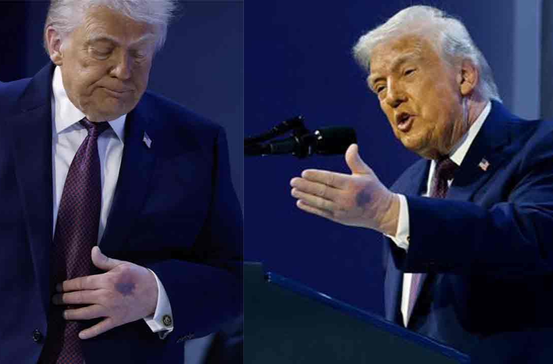 ట్రంప్ చేతిపై ఆ గాయాలేంటి? అమెరికా అధ్యక్షుడి ఆరోగ్యంపై మళ్లీ ఆందోళనలు!