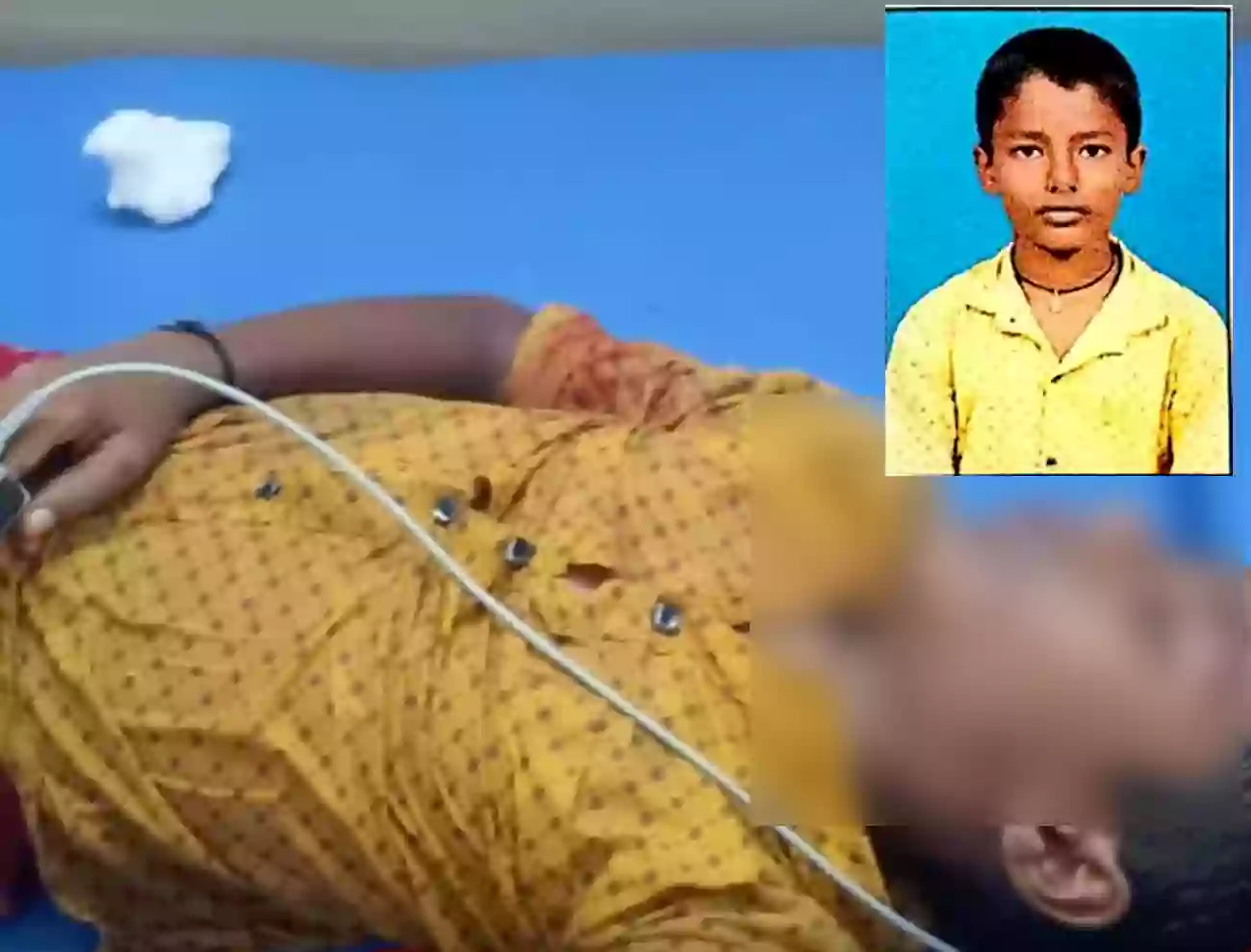గురుకులంలో మరో ప్రమాదం.. హస్టల్ రెండో అంతస్తు నుంచి కిందపడిన విద్యార్థి